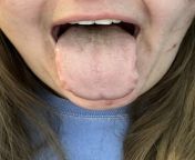 Candida tongue? Where to start if so? We dont have many functional doctors in my area &amp; conventional doctors dont seem like theyd be any help. from doctors brazee