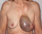 Giant intraductal breast papilloma from giant kalmar