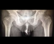 That&#39;s a bizarre X-Ray of a 10-centimeter dining fork, lodged in a 70-year-old man&#39;s penis! This happened as a result of a strange and unlucky sexual accident. from tamil old actress seema x ray photos