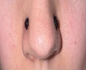 Bad scabbing on nostril piercings. from nostril