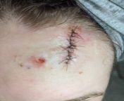 [PSA] Wear your sunscreen and wear a hat PLEASE! 27 years old, a small blemish, about the size of a pencil eraser, turned out to be skin cancer, and now I have a 2 inch gnarly incision on my forehead, along with a second biopsy next to it. I never tannedfrom pimandhost 002 ltress old a