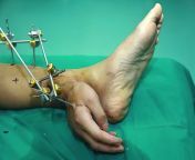 Doctors Kept Chinese Factory Worker Xie Wei&#39;s Hand Alive By Stitching It To Left Ankle. from justina xie