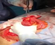A 55 year old man shocked the medical staff when he came to the hospital with severe abdominal pain, after filming it was found that there was a large object stuck in the rectum, and the medical team needed to perform surgery to extract this.. from abdominal