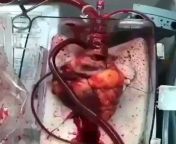 A heart waiting to be transplanted While 88% of patients who underwent heart transplant survived the first year after transplant surgery, the proportion of patients surviving for 5 years; Is 75%. The survival rate for 10 years after surgery is; Is 56%. from doctpr patients