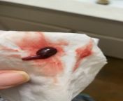 NSFW: Strange Blood Clot (with video) from parent blood pressure xxx video