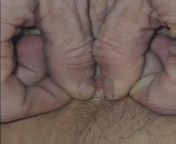 Hormonal Hidradenitis Suppurativa poop on Mons Pubis from mons pubis hd black