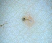 Definitely not my best camera work due to the awkward location of this ingrown and me not being very flexible. Using tweezers to pluck a small peli multigemini and then an ingrown hair on my lady parts. Marked NSFW even tho you can&#39;t see anything. from 550 hair