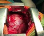 Doctors removing a knife that just missed the heart. It actually pierced the membrane of the heart wall. Warning: Open-heart surgery. [from r/interestingasfuck] from murmur of the heart movie sex scenesngo