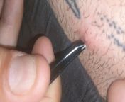 nts how to mark nsfw, but little ingrown hair that was hurting, hurt sm to get out and I pulled out a second hair after from little first hair