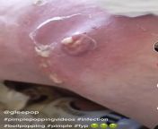 Juicy thigh abscess being drained into a cardboard box! Not OC Full video clip but will post TikTok link if you want. from full video megnutt02 nude megan guthrie tiktok star leaked mp4 download file