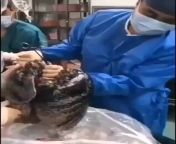 In this video, we are looking at the blackened lungs of a 52-year-old man who smoked about 1 pack a day for ~ 30 years. The patient had signed up to donate his organs after death, but doctors quickly realized that they would not be able to use them. We ca from tkender sagar xxxww xxx video old man